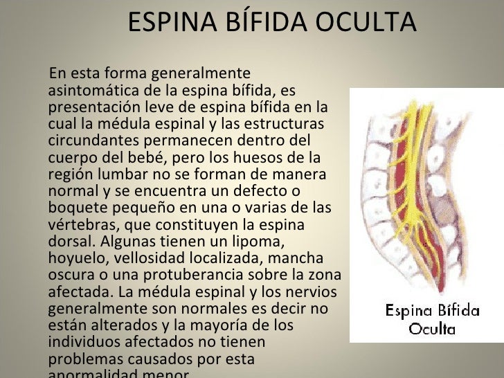 espina bifida oculta